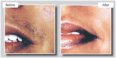 beforeafter